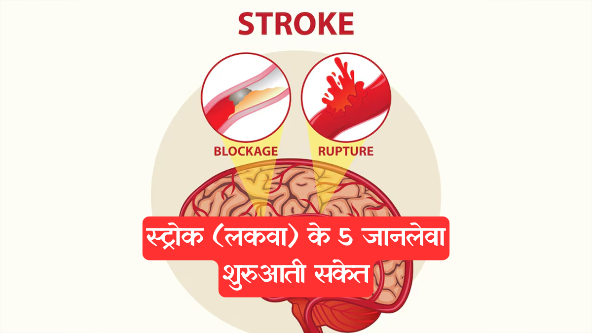 Stroke: साइलेंट किलर 'स्ट्रोक', इन 5 लक्षणों को मामूली समझने की भूल न करें