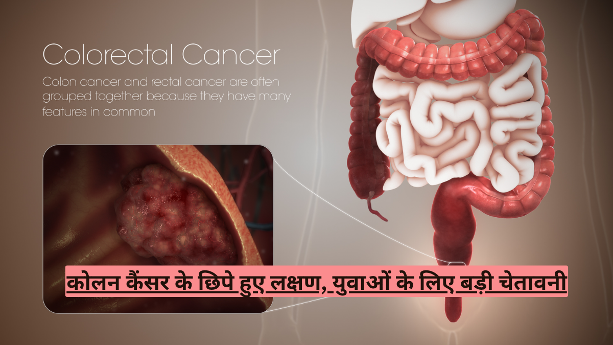 कोलन कैंसर के छिपे हुए लक्षण, युवाओं के लिए बड़ी चेतावनी