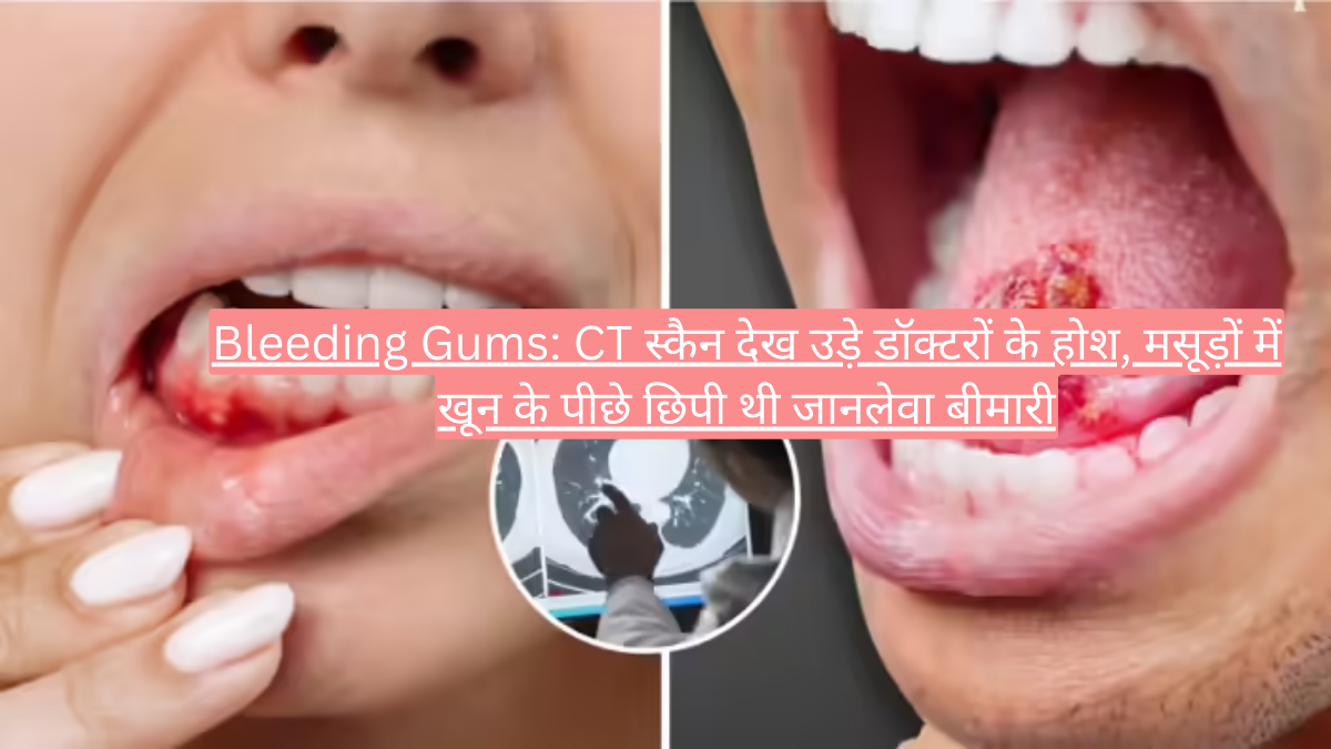 Bleeding Gums: CT स्कैन देख उड़े डॉक्टरों के होश, मसूड़ों में खून के पीछे छिपी थी जानलेवा बीमारी